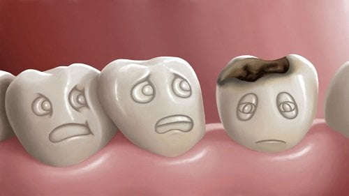Bọc răng hàm bị sâu giá bao nhiêu là tốt nhất? 1