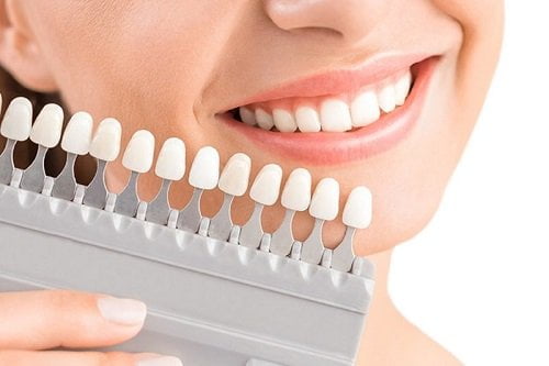Chỉnh răng đều không cần niềng bằng cách nào? 2
