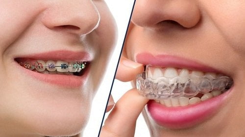 Niềng răng có nguy hiểm không? Lời khuyên từ nha khoa 2