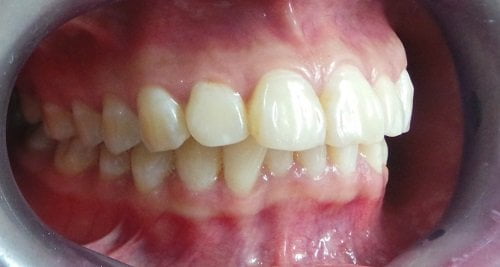 Phương pháp chữa răng hô không cần niềng đơn giản 1