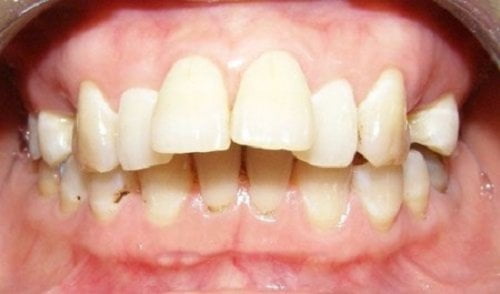 Phương pháp chữa răng hô không cần niềng đơn giản 2