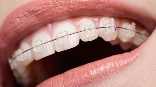 Niềng răng 1 hàm có đau không? Thông tin cần nắm 2