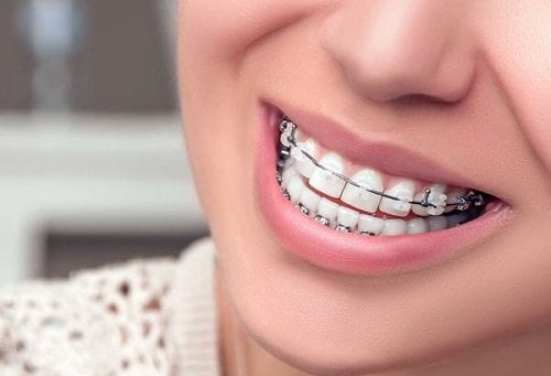 Niềng răng móm trong bao lâu kết thúc điều trị? 1