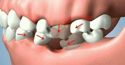 Trồng răng giả có đau không? Những thông tin cần biết 1