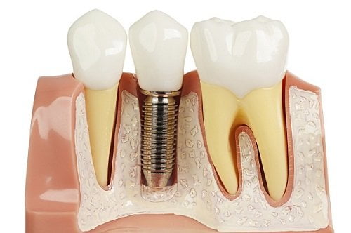 Kinh nghiệm làm răng implant cho bạn hiệu quả 1