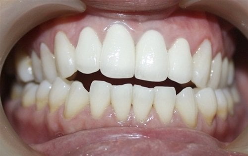 Niềng răng khớp cắn hở - Giải pháp điều trị hiệu quả 1