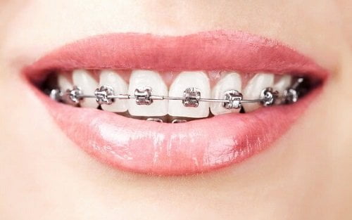 Niềng răng khớp cắn hở - Giải pháp điều trị hiệu quả 2