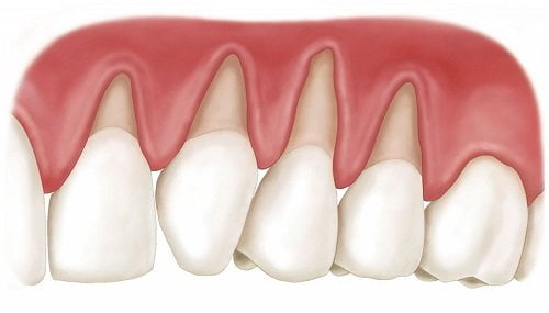 Niềng răng bị lòi chân răng - Các cảnh báo từ nha khoa 1