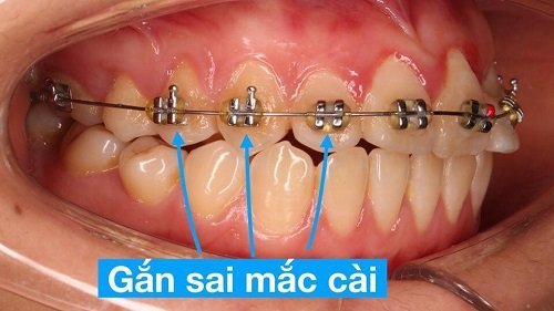 Niềng răng bị lòi chân răng - Các cảnh báo từ nha khoa 2