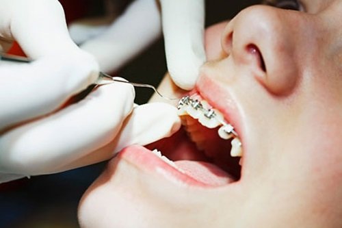 Niềng răng bị lòi chân răng - Các cảnh báo từ nha khoa 3