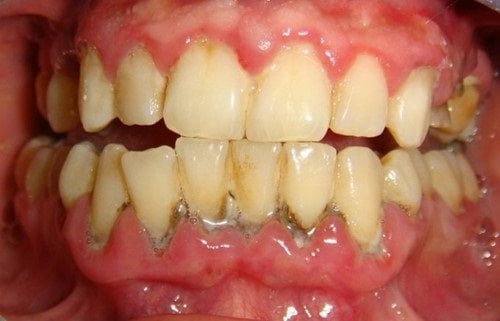 Tẩy trắng răng bao nhiêu tiền? Cập nhật chi phí mới 1