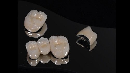 Có nên trồng răng sứ kim loại không? Giải đáp từ nha khoa 2