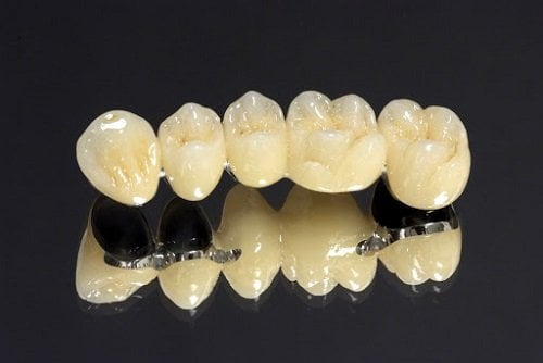 Có nên trồng răng sứ kim loại không? Giải đáp từ nha khoa 3