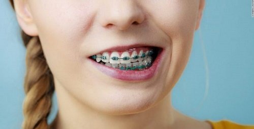 Niềng răng lệch hàm có hiệu quả như mong muốn không? 1