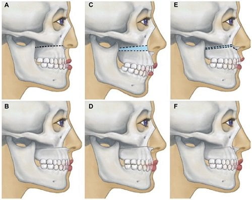 Niềng răng lệch hàm có hiệu quả như mong muốn không? 3