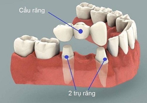 Trồng răng bằng cầu răng cho trường hợp nào? 1