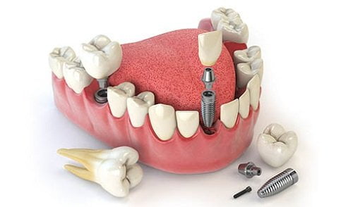 Trồng răng bằng cầu răng cho trường hợp nào? 3
