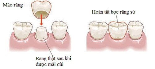 Bọc răng sứ có ảnh hưởng gì không? Tham khảo 3