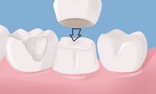 Chụp răng sứ giá bao nhiêu tiền tại nha khoa? 2