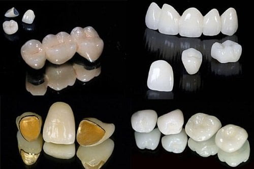 Chụp răng sứ giá bao nhiêu tiền tại nha khoa? 3