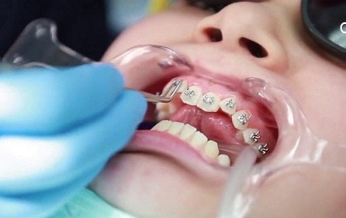 Ê buốt khi niềng răng - Tình trạng trong quá trình niềng răng 2