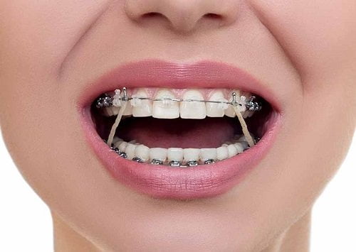 Niềng răng giai đoạn nào đau nhất? Tham khảo 1
