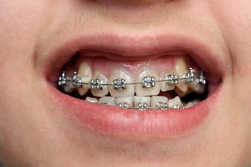 Niềng răng hô mất thời gian bao lâu? Tham khảo quy trình thực hiện 2