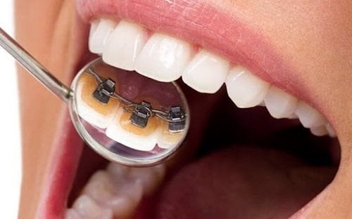 Niềng răng mặt trong giá rẻ bao nhiêu tiền? 1