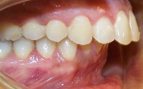 Niềng răng hàm trên mất bao lâu? Dựa vào yếu tố nào? 1