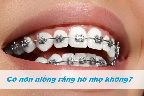 Niềng răng hàm trên mất bao lâu? Dựa vào yếu tố nào? 2