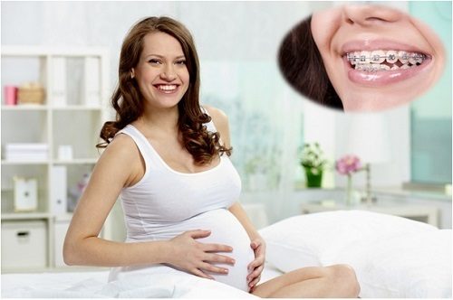 Niềng răng khi mang thai - Tìm hiểu thông tin liên quan 2