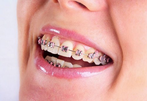 Niềng răng làm răng lung lay có sao không? 2