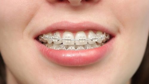 Niềng răng lệch nhân trung - Kiến thức liên quan 2