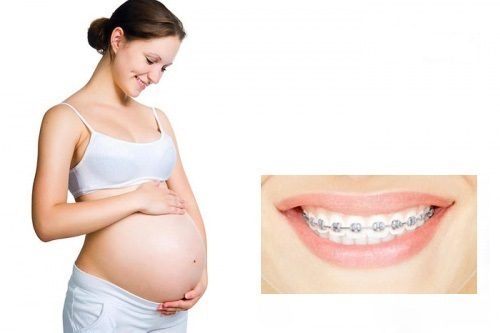 Niềng răng bao lâu thì nên có bầu - Lời khuyên từ nha khoa 1