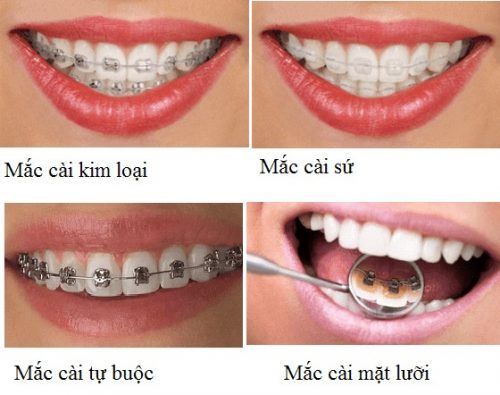 Niềng răng thưa 1 hàm giá bao nhiêu? Trung tâm nha khoa giải đáp 3