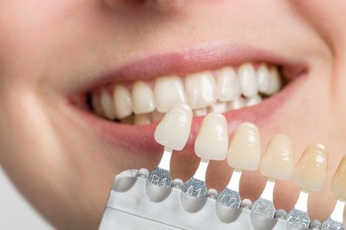 Có nên đi tẩy trắng răng không? Cần giải đáp thắc mắc 2