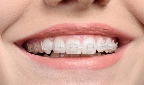 Niềng răng pha lê giá bao nhiêu? *
