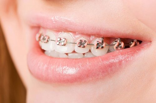 Niềng răng bị hỏng phải khắc phục như thế nào? 1