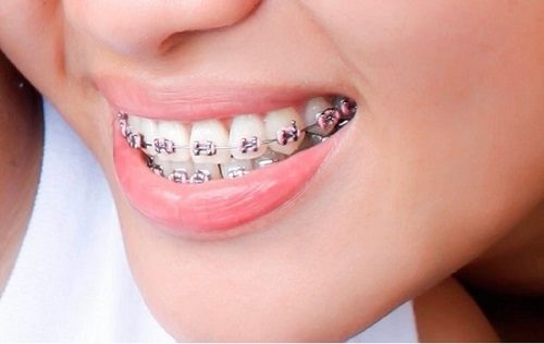 Niềng răng bị hỏng phải khắc phục như thế nào? 2
