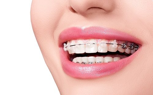 Niềng răng bị hỏng phải khắc phục như thế nào? 3