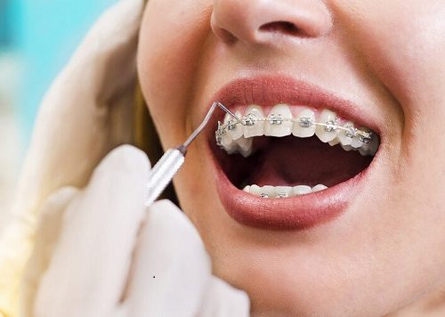Niềng răng có ảnh hưởng đến sức khỏe không? 1