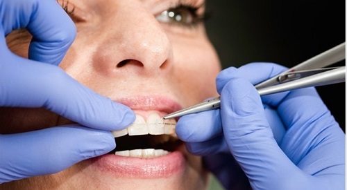 Niềng răng có ảnh hưởng đến sức khỏe không? 3