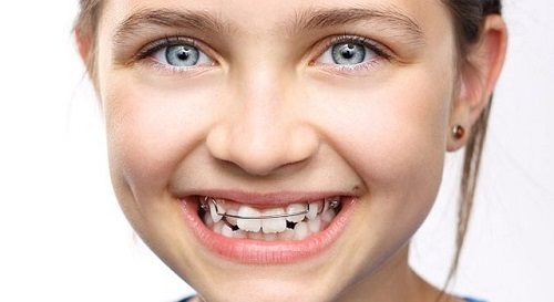 Niềng răng cho trẻ 10 tuổi lưu ý điều gì? 1