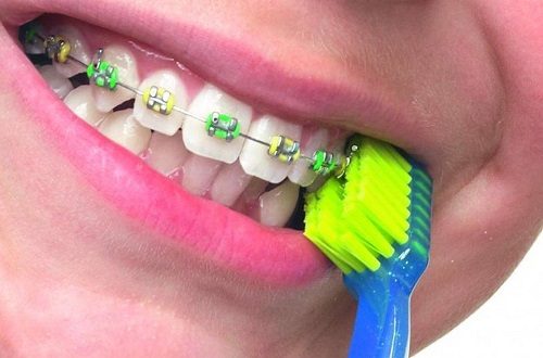 Niềng răng dùng bàn chải gì là hợp? 2