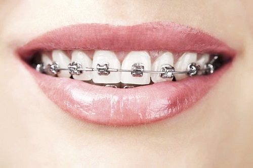 Niềng răng hô hàm trên bao nhiêu tiền? 1