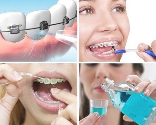 Niềng răng ăn cháo bao lâu là được? 3