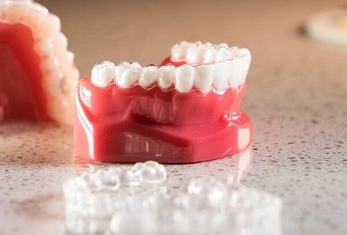 Niềng răng hơi hô mất bao lâu thì có kết quả? 2
