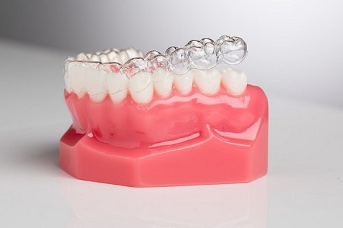 Niềng răng hơi hô mất bao lâu thì có kết quả? 3