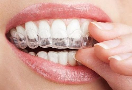 Niềng răng invisalign có nhổ răng không? 3