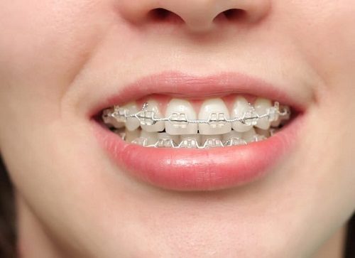 Niềng răng có nên dùng bàn chải điện - Lợi ích từ bàn chải điện 1